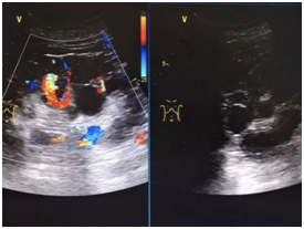 肾脏超声检查在体检中的重要性